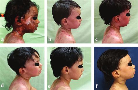 A 3 Year Old Boy With Superficial And Deep Dermal Burns To The Face