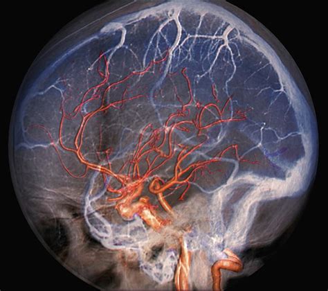 Brain Blood Vessels Photograph By Zephyrscience Photo Library