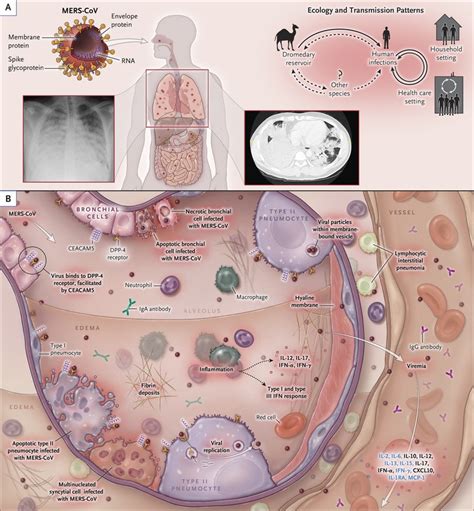 Middle East Respiratory Syndrome Nejm