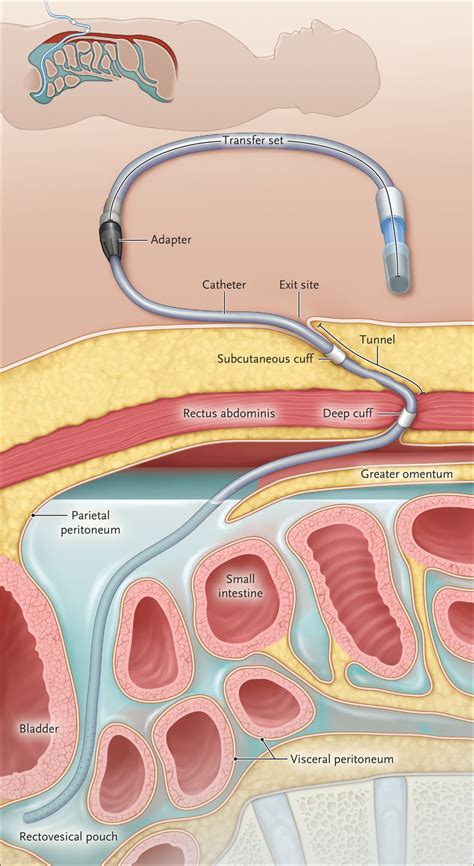 Peritoneal Dialysis Catheter Transfer Set Brightloan Ae