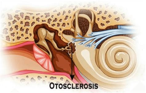 Otosclerose Causas Sintomas E Tratamentos Saiba Tudo Biosom