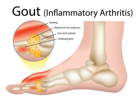 Understanding the Stages of Gout A Comprehensive Overview Tin Tức 24H