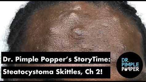 Dr Pimple Poppers Weekly Story Steatocystoma Skittles Chapter 2
