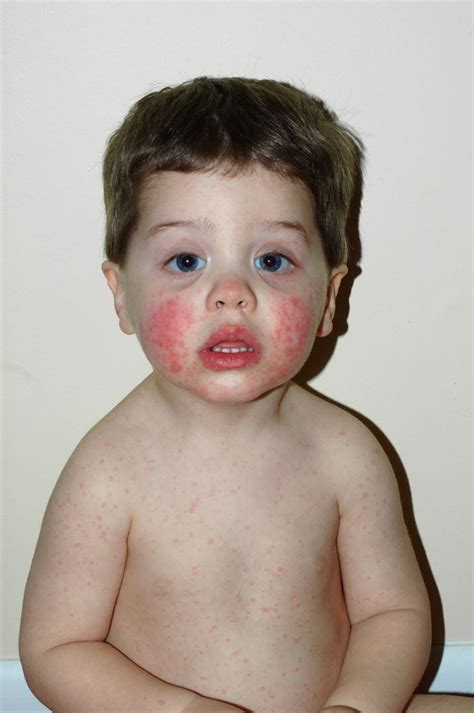 Image Erythema Infectiosum Msd Manual Professional Edition