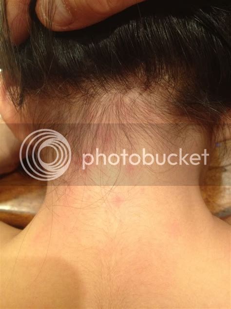Help What Is This Dd Has Bite Marks On Her Neck And Eyebrow