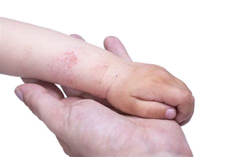 Os Principais Sintomas Da Dermatite Dicas De Muscula O