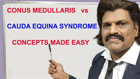 Conus Medullaris Vs Cauda Equina Syndrome Concepts Made Easy Youtube