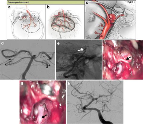 Representative Subtemporal Approach To Basilar Artery Aneurysms Ac