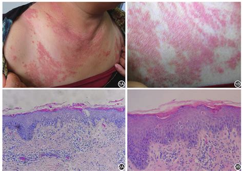 Persistent Papules With Adult Onset Stills Disease A Case Report