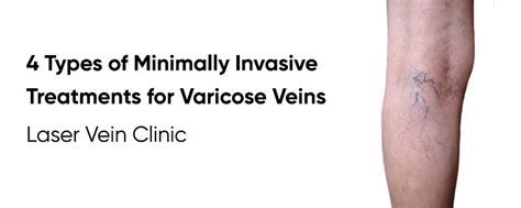 4 Minimally Invasive Types Of Treatments For Varicose Veins