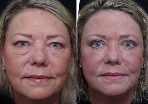 Laser Skin Resurfacing Before And After Brian S Biesman Md