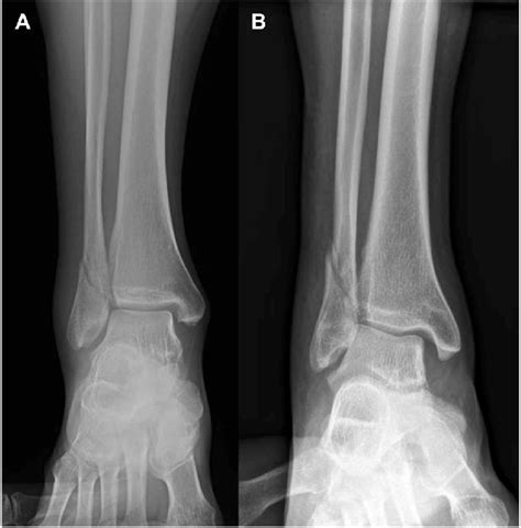 Example Stress View Radiographs Of Isolated Lateral Malleolar