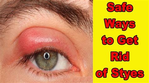 How To Get Rid Of A Stye 7 Easy And Safe Ways To Get Rid Of Styes