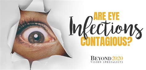 Are Eye Infections Contagious Beyond 2020 Vision Specialists