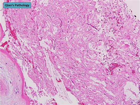 Qiaos Pathology Amnion Nodosum Microscopic Photo Showing Flickr