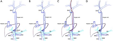 Cardiac Catheterization Schema A Abernethy Malformation Type Ii