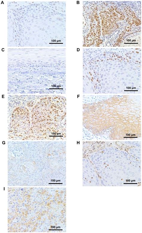 Immunohistochemical Staining Showing Low And High Expressions Of A And