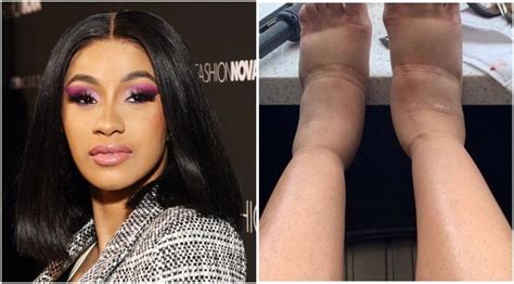 Cardi B May Have Major Damage From Plastic Surgery Plastic Surgery