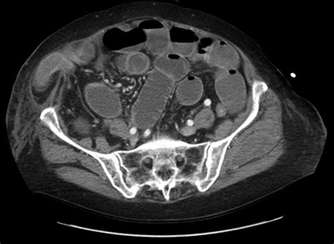Hernia On Ct Scan