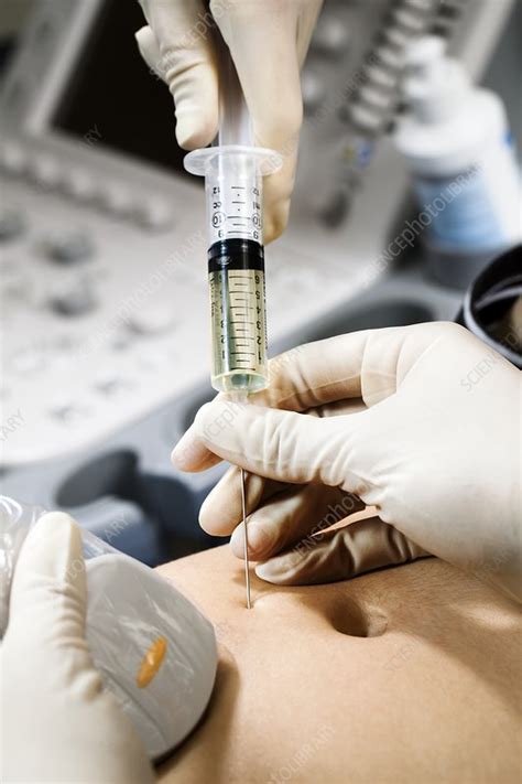 Like all other homemade pregnancy tests, it also identifies the presence of note: Amniocentesis test in pregnancy - Stock Image - C017/7163 ...