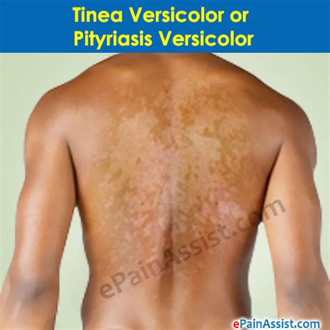 Tinea Pityriasis Versicolor Etiology Clinical Manifestations Diagnosis