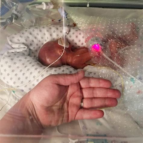 One Of Britains Most Premature Babies Weighing Just Over 1lb