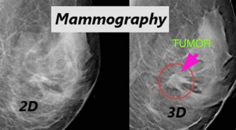 3 D Mammography Increases Breast Cancer Detection Radiology In North