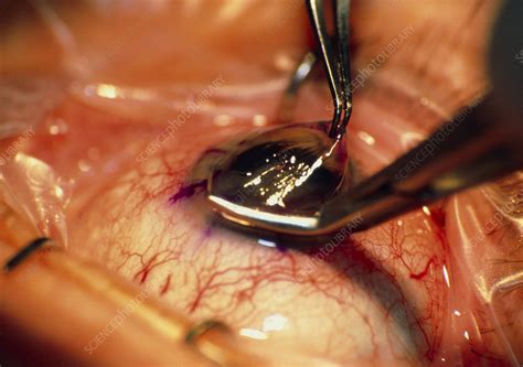 Eye Surgery Stock Image M5700119 Science Photo Library