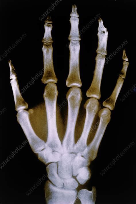 X Ray Photo Of Normal Right Hand Stock Image P1160002 Science