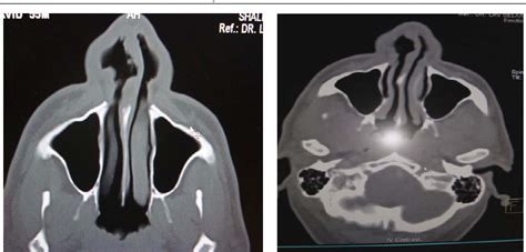 Figure 1 From Primary Nasal Septal Tubercular Abscess In Hiv Patient