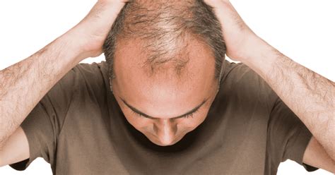 Traitement Non Chirurgical Perte Cheveux Cas De Traitement Alopécie Aag
