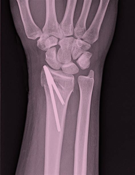 T Pin For Distal Radius Fracture Activities Of Daily Living