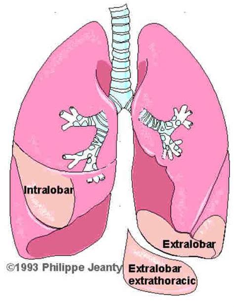 📃 Lung Sequestration Extralobar Subdiaphragmatic