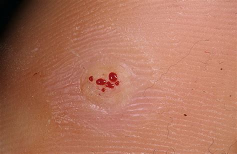 These warts are extremely contagious, and infection can jump from your hands to your face via touch and nail biting. Plantar Wart Pictures - 20 Photos & Images / illnessee.com