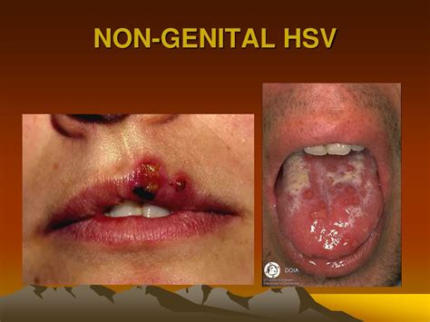 herpes genital non traité aciclovir herpès génital Swhshish