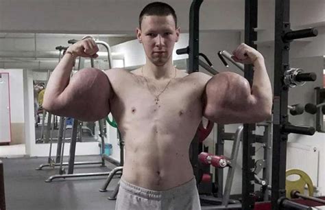 Russian Popeye Has Life Saving Surgery To Remove Chemicals From His Biceps Plastic Surgery