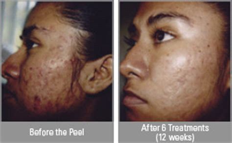 Hydroquinone might cause black freckles to appear on dark skin if it is used for an extended period i've been researching chemical peels for hyperpigmentation for a few days. Skin Medica Chemical Peels: Illuminize, Vitalize ...