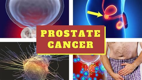 Prostate Cancer Symptoms Causes Symptoms And Pictures Of Prostate Cancer Enlarged Prostate
