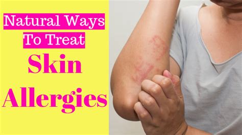 Skin Allergies Home Remedies 10 Ancient Ways To Overcome Naturally