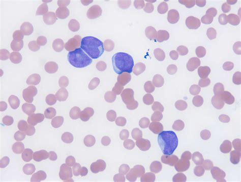 Peripheral Blood Smear Showing Immature Myeloid Cells Myeloblasts