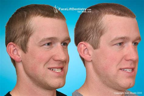Even normal aging can lead to an overbite as the teeth can continue to move with age. Is Your Jaw Better Than Mine? (pics) - Page 4 ...