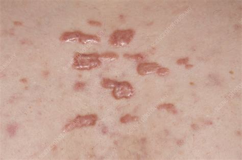 Keloid Scars In Acne Vulgaris Stock Image C0085640 Science Photo