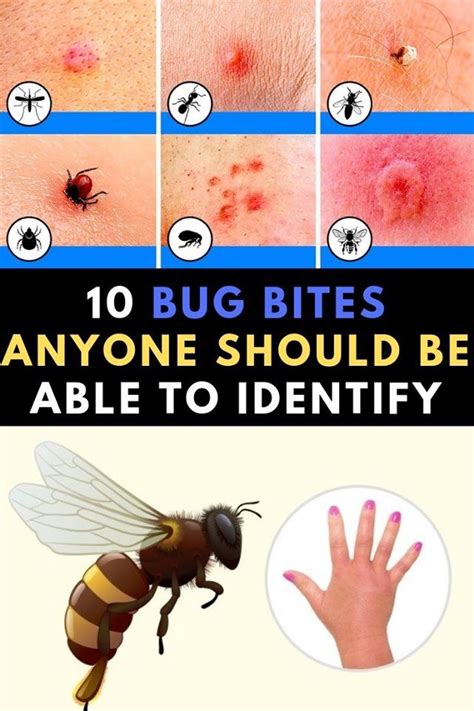 10 Bug Bites Anyone Should Be Able To Identify Bug Bites