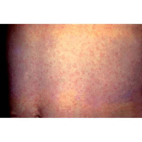 What Do Measles Look Like