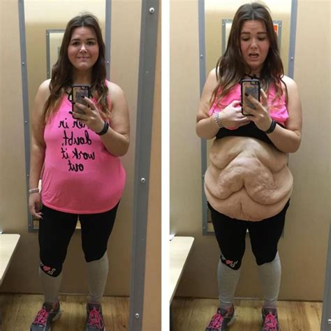 Woman Who Lost 185 Lbs Shows Off Excess Skin I Wanted People To Realize What Obesity Does