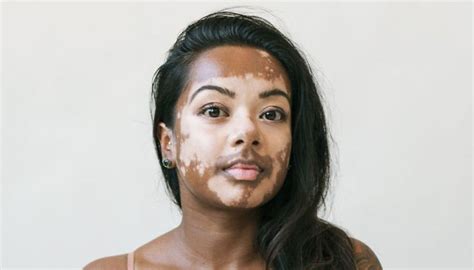35 Belles Femmes Atteintes De Vitiligo Photographiées Par Un