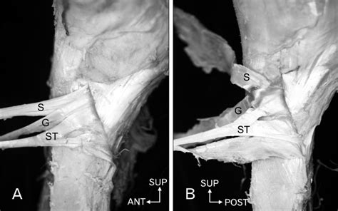 Variation Of The Semitendinosus Tendon At The Insertion Site A The