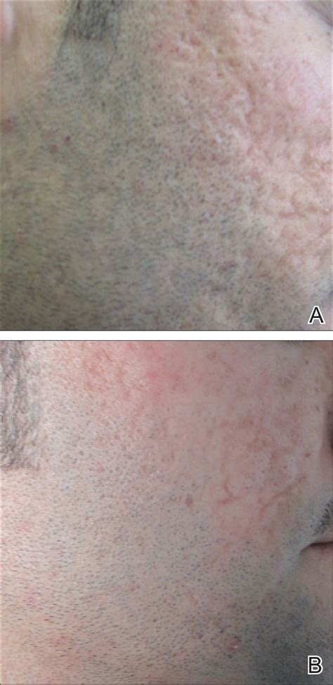 Update On Acne Scar Treatment Mdedge Dermatology