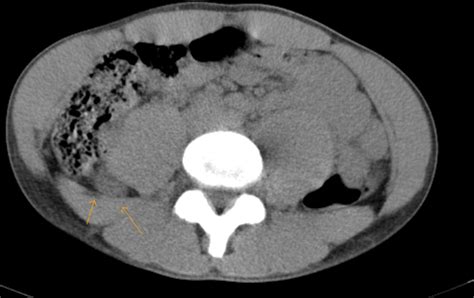 Appendicitis Ct Sumers Radiology Blog