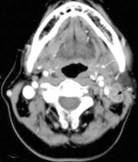 Figure 1tonsillar Squamous Cell Carcinoma Associated With